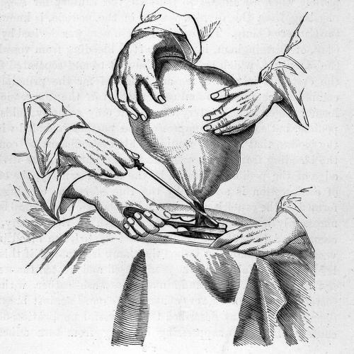 A line drawing of an operation on an ovarian cyst from Wells’ book Diseases of the ovaries: their diagnosis and treatment.