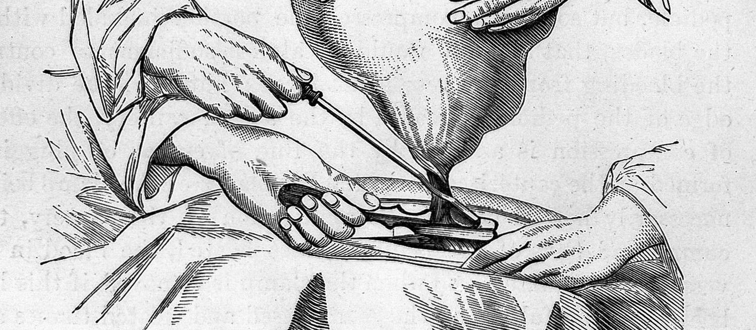 A line drawing of an operation on an ovarian cyst from Wells’ book Diseases of the ovaries: their diagnosis and treatment.